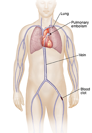 Front view of male figure with arrow showing path of blood clot from leg vein to lung, causing pulmonary embolism.