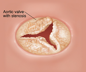 Top view of open aortic valve with stenosis.