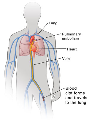 Outline of man's torso showing heart, lungs, and major veins. Blood clot is in leg vein with arrow showing it traveling up vein to lung.