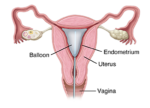 Front view cross section of uterus showing catheter inserted through vagina and ablation balloon inside uterus.
