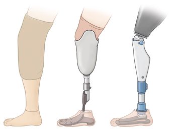 Three types of leg prostheses.
