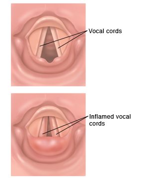 Top view of normal vocal cords. Top view of inflamed vocal cords.