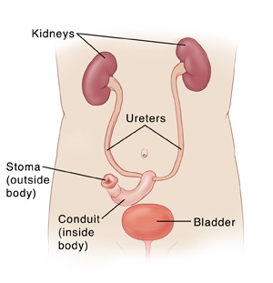 Front view of torso showing kidneys connected to conduit and stoma by ureters. Bladder is not connected to ureters.