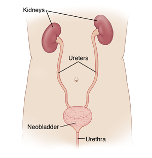 Front view of male torso, showing kidneys connected to neobladder by ureters. The neobladder connects to urethra.