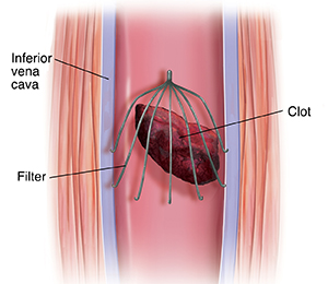 Cross section of inferior vena cava with filter trapping embolus.