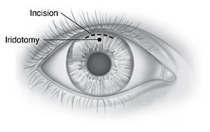 Front view of eye showing incision at top of iris, and hole for iridotomy.
