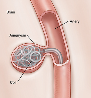 Closeup of small artery partly in cross section to show wire coil being placed in aneurysm.