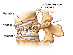 Side view of vertebra with compression fracture. Needle is injecting cement into fracture.