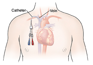 Outline of man's chest showing heart with central line in place.