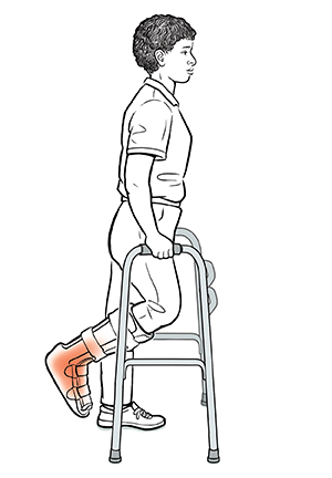 Woman standing with knee bent to raise injured foot behind her, holding on to walker grips. Her uninjured foot is just inside walker legs, ready to move walker forward for a step using non-weight bearing technique.