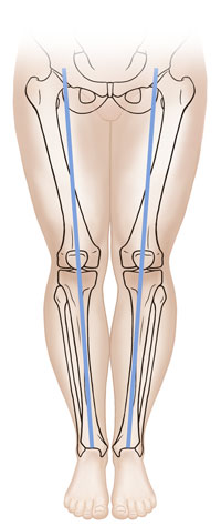 Front view of child's legs showing bones aligned normally.