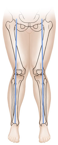 Front view child's legs showing bones with knock knees.