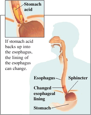 Acid+reflux+disease