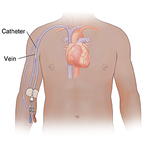 Front view of male chest showing midline catheter inserted just above elbow and ending in upper arm.