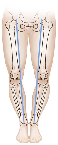 Front view child's legs showing bones with bowlegs.
