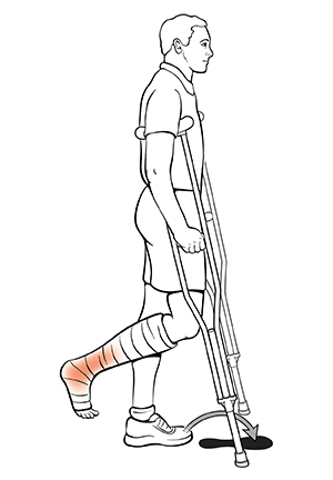 Vista lateral de un hombre usando muletas. La flecha indica dónde colocar el pie para la técnica semipendular.