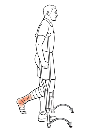 Vista lateral de un hombre usando muletas. La flecha indica dónde colocar el pie después de avanzar para la técnica semipendular.