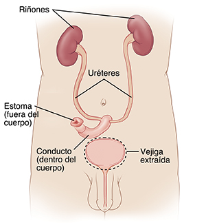Vista delantera de un torso masculino, donde pueden verse los riñones conectados al conducto y el estoma por medio de los uréteres. Se ha extraído la vejiga.