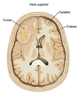 Vista superior de un corte transversal del cerebro donde puede verse un tumor.