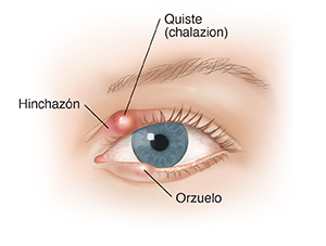 Vista frontal de un ojo con blefaritis.