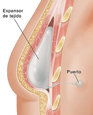 Corte transversal de un seno donde puede verse un expansor de tejido después de una mastectomía.