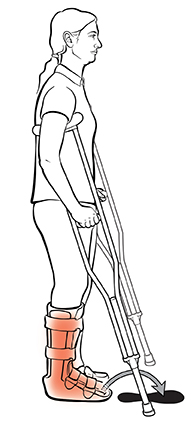 Vista lateral de una mujer con muletas, con flechas que muestran adónde debe ir el pie herido al caminar, entre las muletas.