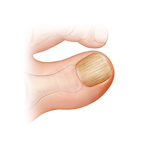 Primer plano de un dedo gordo del pie con una uña gruesa.