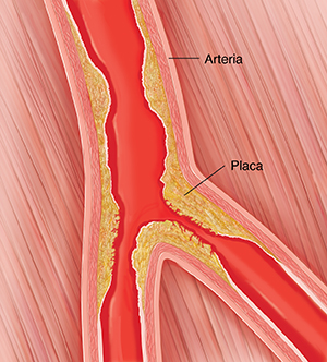 Corte transversal de una arteria periférica con acumulación de placa.
