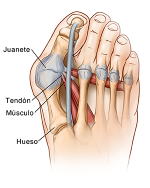 Pie y dedos de los pies donde puede verse el dedo gordo inclinado en la base, lo que forma un juanete.