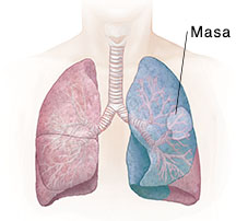 Vista frontal del pecho donde pueden verse los pulmones. La zona sombreada muestra una lobectomía.