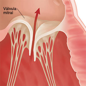 Primer plano de una válvula cardíaca que no puede cerrarse por completo. Una flecha muestra el flujo de sangre que regresa a través de la válvula.
