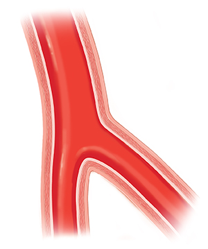 Corte transversal de una arteria saludable.