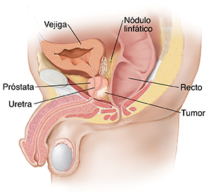 Vista lateral de los órganos pélvicos masculinos en la que se ve un tumor en la próstata.