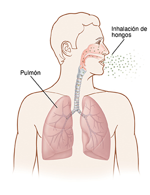 Contorno de una cabeza y un pecho humanos con la cabeza girada hacia un lado. Pueden verse el interior de la nariz, las vías respiratorias y los pulmones. Se inspira el hongo por la nariz y los pulmones.