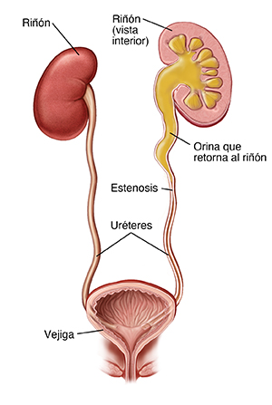 Vista frontal de un corte transversal de los riñones, los uréteres y la vejiga. El uréter izquierdo está cerrado y la orina regresa al riñón.