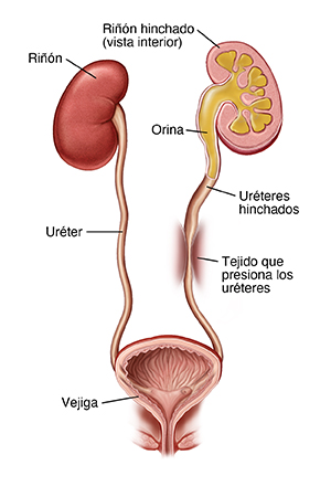 Vista frontal de los riñones, los uréteres y la vejiga. El tejido que rodea un uréter lo está comprimiendo y hace que la orina regrese al riñón.