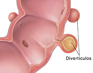 Corte transversal del colon sigmoide donde puede verse diverticulitis.