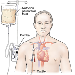 Vista frontal de un hombre donde se muestra un corazón con una vía central conectada a una bomba intravenosa.