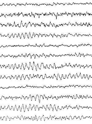 Doce líneas paralelas muestran formas de onda normales en un gráfico de electroencefalografía (EEG). Las líneas son regulares y repiten un patrón de picos y valles pequeños.