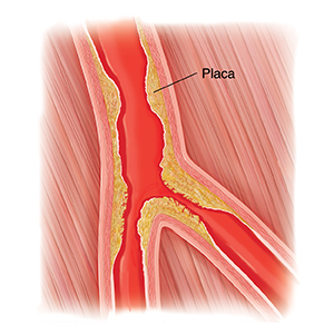 Corte transversal de una arteria periférica estrechada por acumulación de placa.