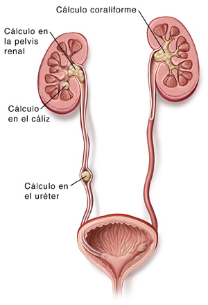 Corte transversal de los riñones, los uréteres y la vejiga donde se indica la ubicación de los cálculos renales.