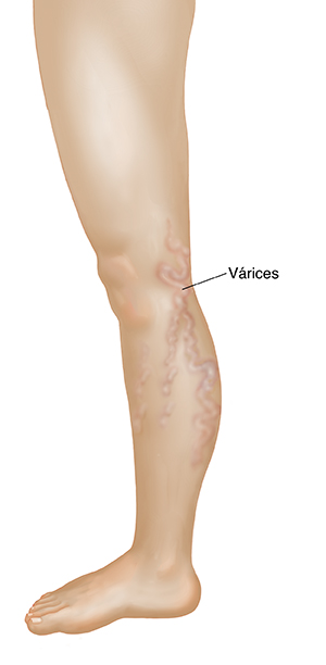 Vista lateral de pierna con venas varicosas.
