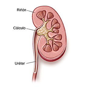 Corte transversal del riñón y del uréter donde se muestra un cálculo renal grande.