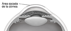 Corte transversal lateral del frente de una córnea en donde se ve que se ha extirpado una zona de la córnea con láser.