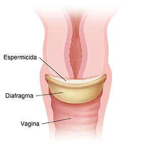 Diafragma con espermicida colocado en el cuello uterino.