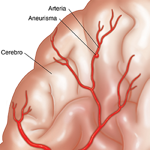 Primer plano de un cerebro donde se observa un aneurisma micótico en una arteria.