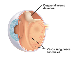 Vista del corte transversal de un ojo donde se observa la retinopatía del prematuro.