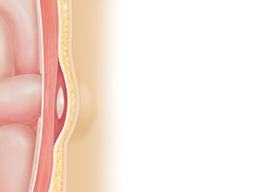 Corte transversal de una pared corporal donde puede verse una hernia. El intestino sobresale levemente por el defecto en el músculo debajo de la piel.