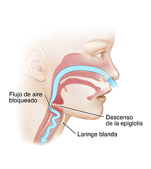 Vista lateral de la cara de un niño donde se ve que el aire no puede pasar debido a una laringomalacia.