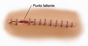 Vista superior de la herida suturada en la que se observan puntos faltantes y abertura parcial de la herida (dehiscencia).